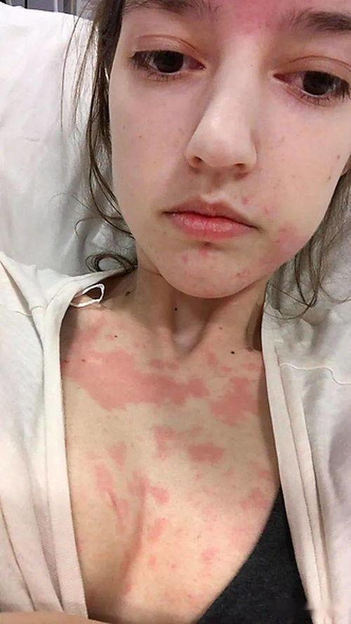 娱乐吃瓜酱过敏,吃瓜酱过敏背后的惊人真相